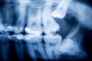 18908347 - x-ray of problematic wisdom teeth