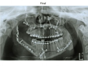 311771--ortodoncia-carlton-patologia3.w1024