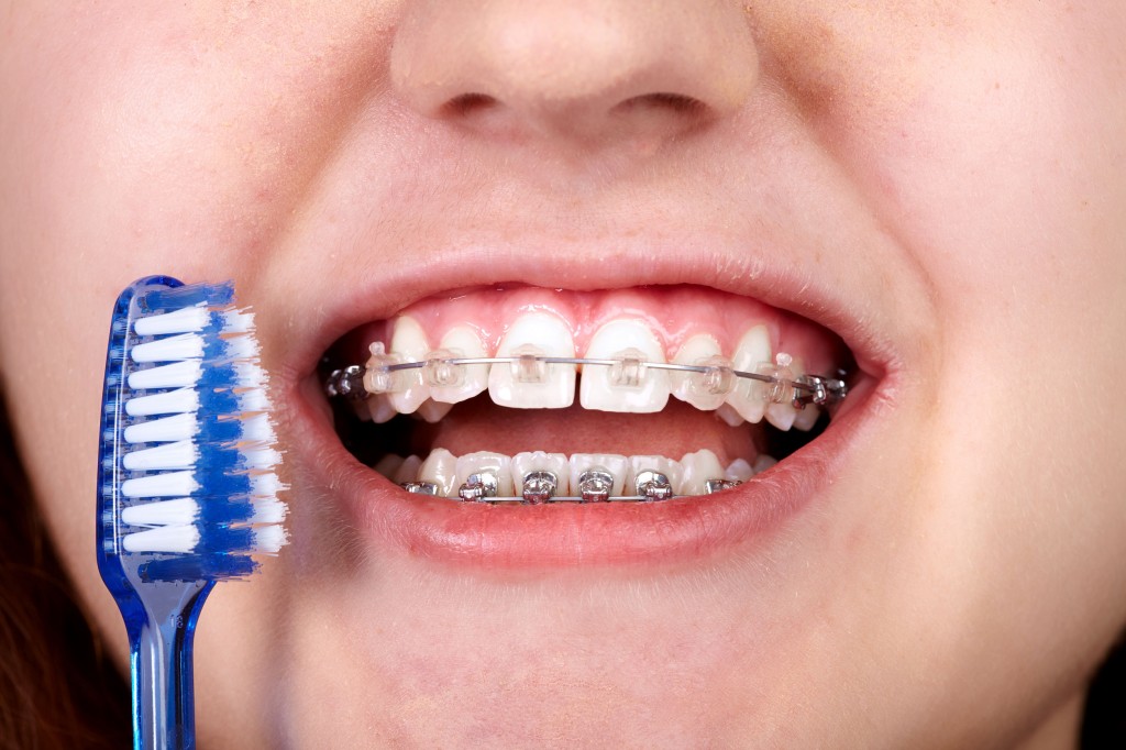 45241139 - teeth with orthodontic brackets. dental health care.