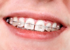 45791521 - teeth with orthodontic brackets. dental health care.