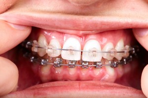 45241141 - teeth with orthodontic brackets. dental health care.
