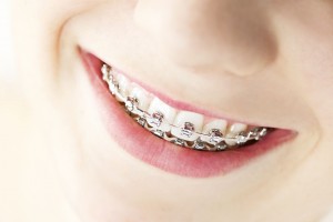 13306524 - closeup on braces and white teeth of smiling girl