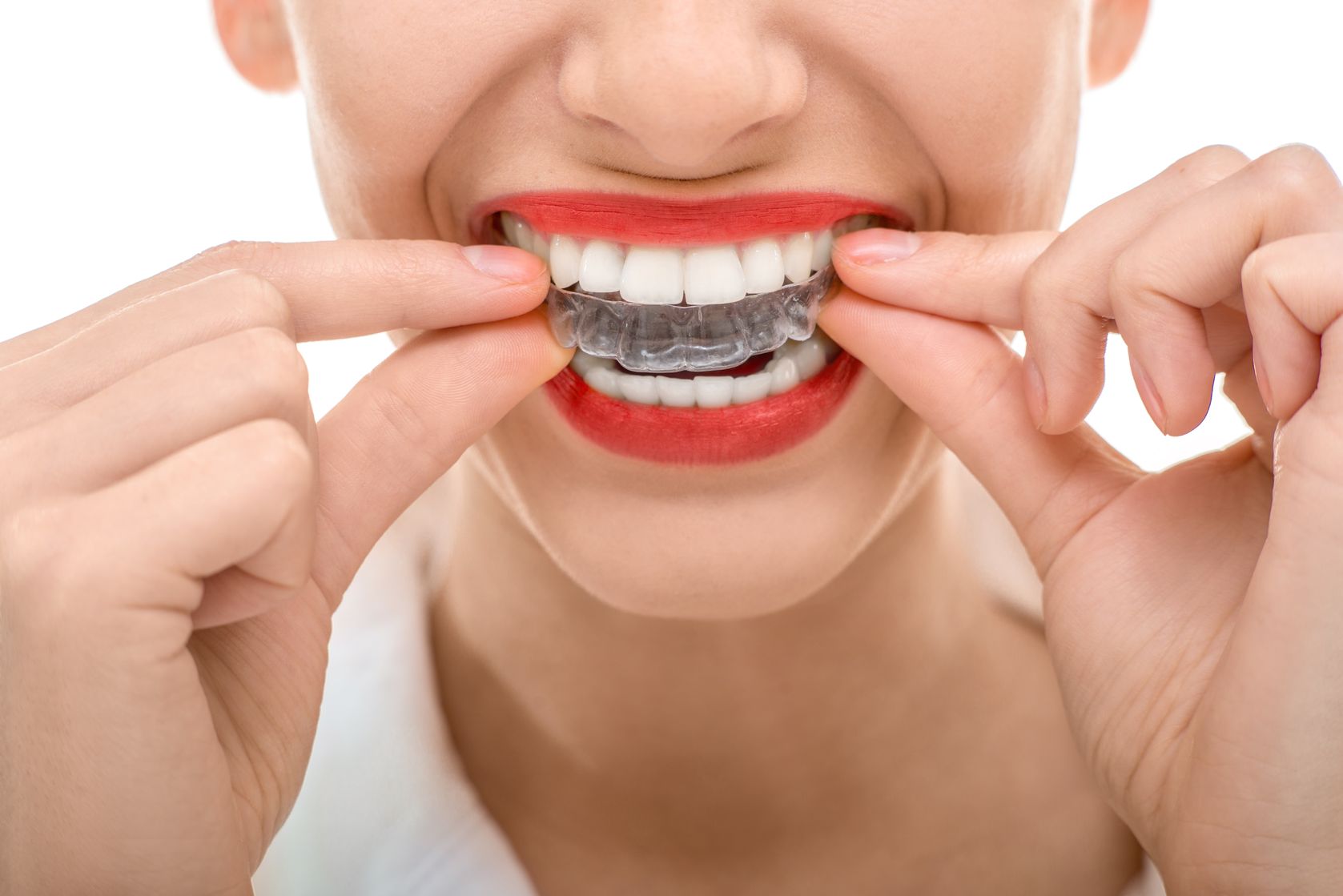 Cómo limpiar correctamente nuestra férula dental? - Ortodoncia Carlton