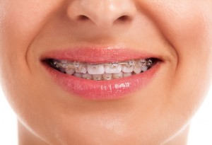 27767122 - womans smiling showing white teeth with braces