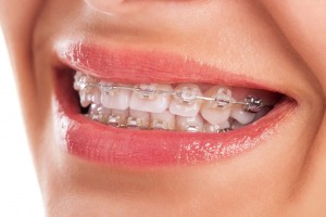 27849488 - perfect teeth with braces isolated