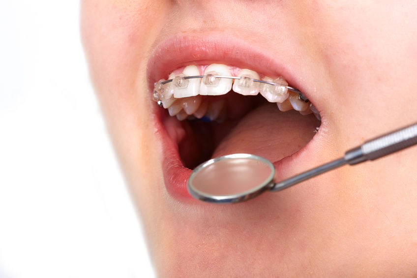 46267108 - teeth with orthodontic brackets. dental health care.