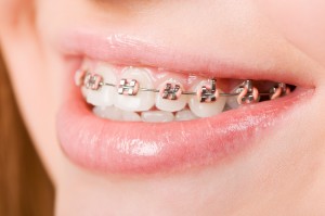 12916249 - beautiful young woman with brackets on teeth close up