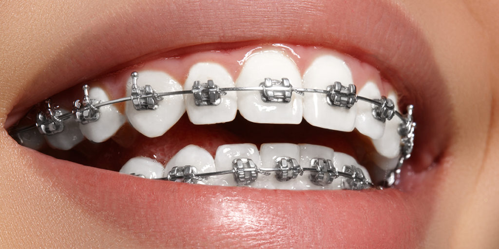 cuidar-los-dientes-durante-tratamiento-ortodoncia-1024x511